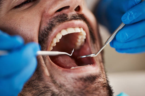Best Emergency Dental Care for Broken or Chipped Teeth in Poulsbo, WA